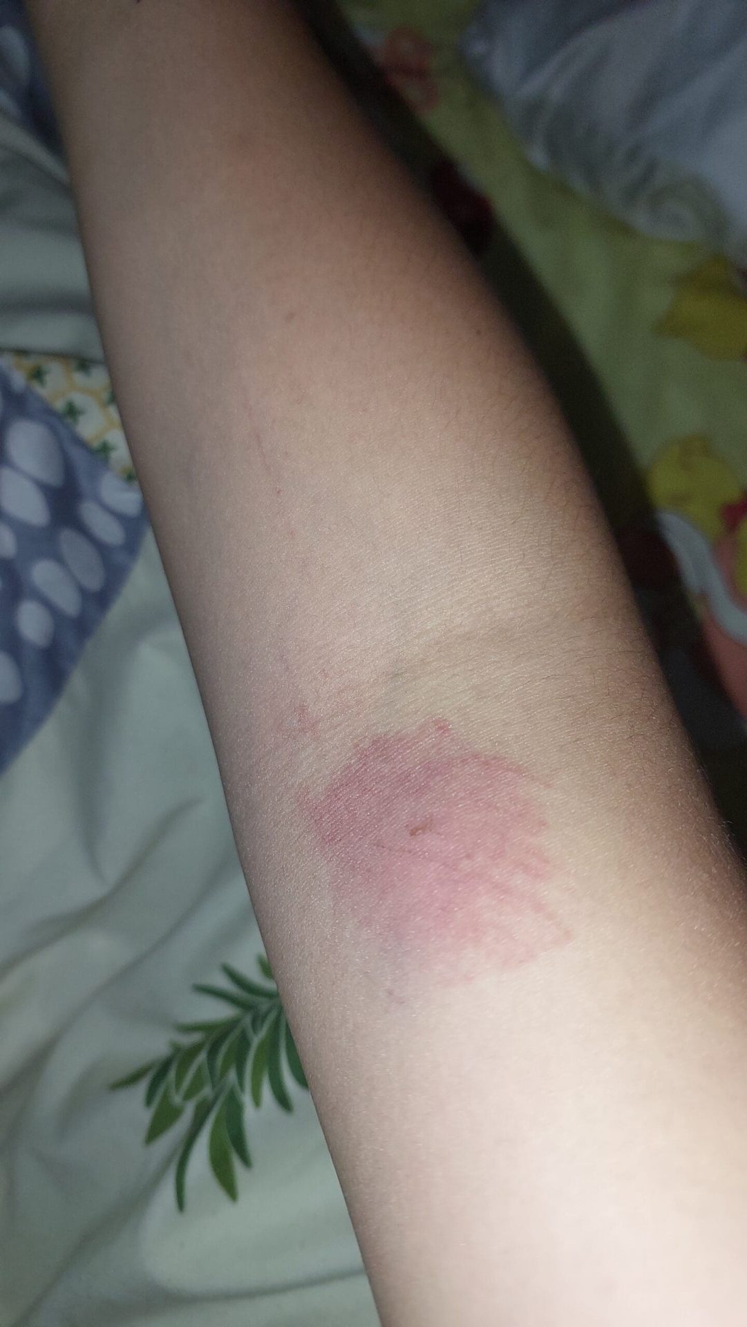 Woman's hand bruised up