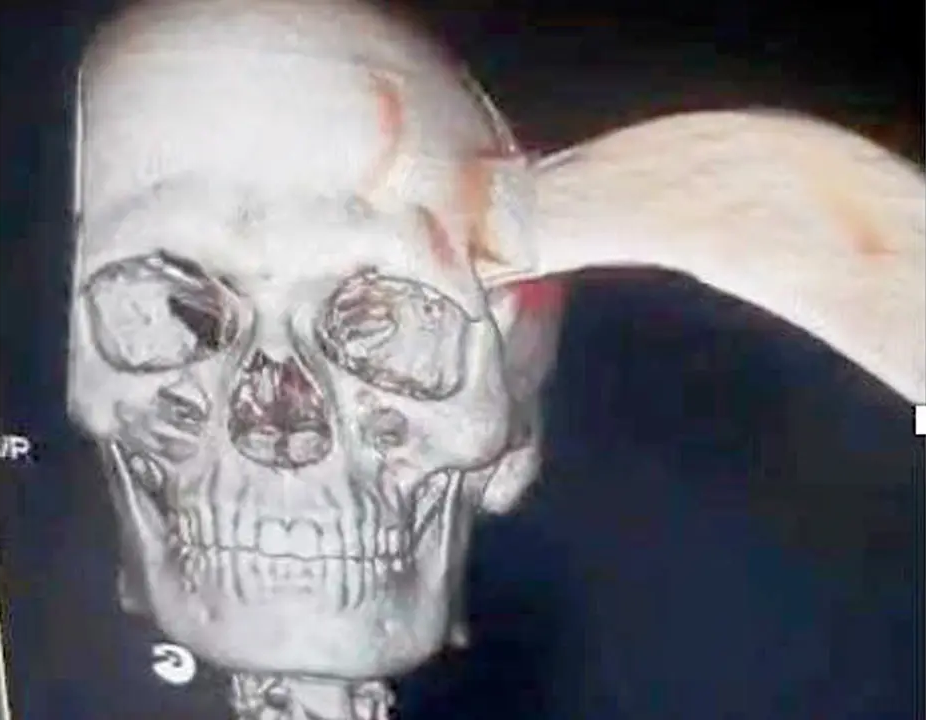 Indian man has machete in head (3)