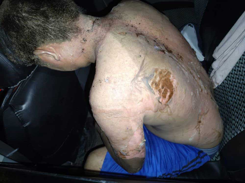 Sabah man suffers burn saving brother china press