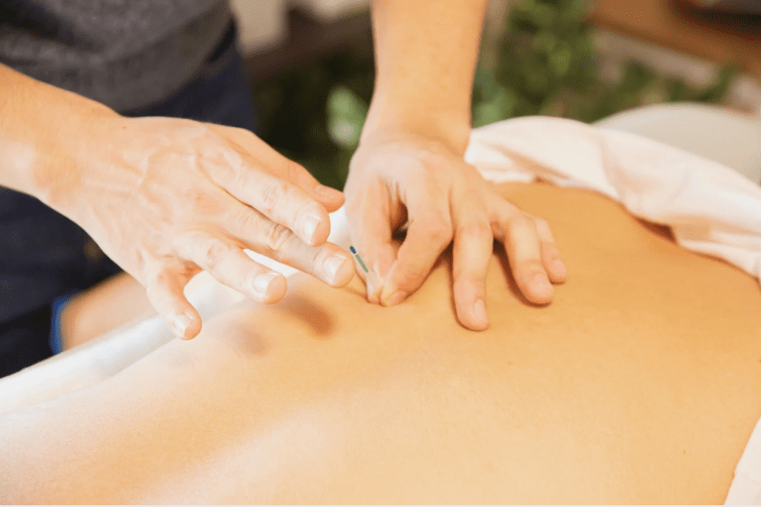 acupuncture needle