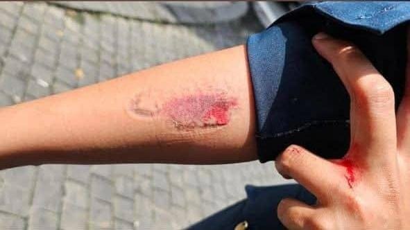 bitten wound