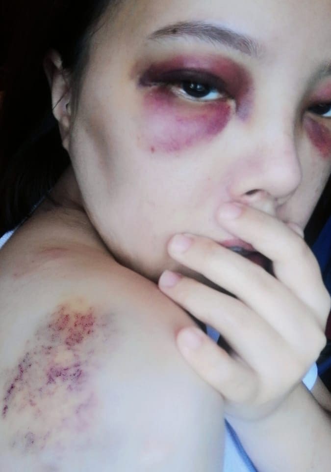 Ai FM DJ Shuleen's body and eyes badly bruised