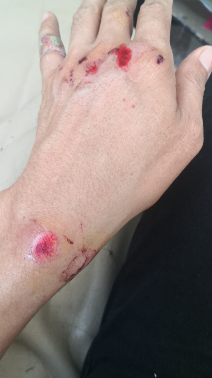 Lin's hand injuries while rescuing son from kidnappers