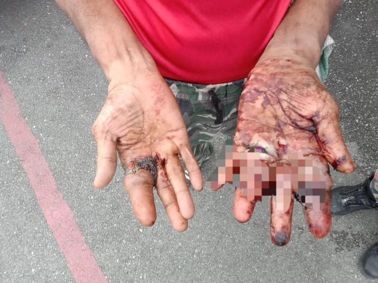 Man's hands become swollen due to rings being worn too tightly