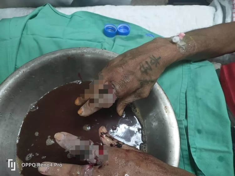 Man's hands being washed with sodium chloride solution