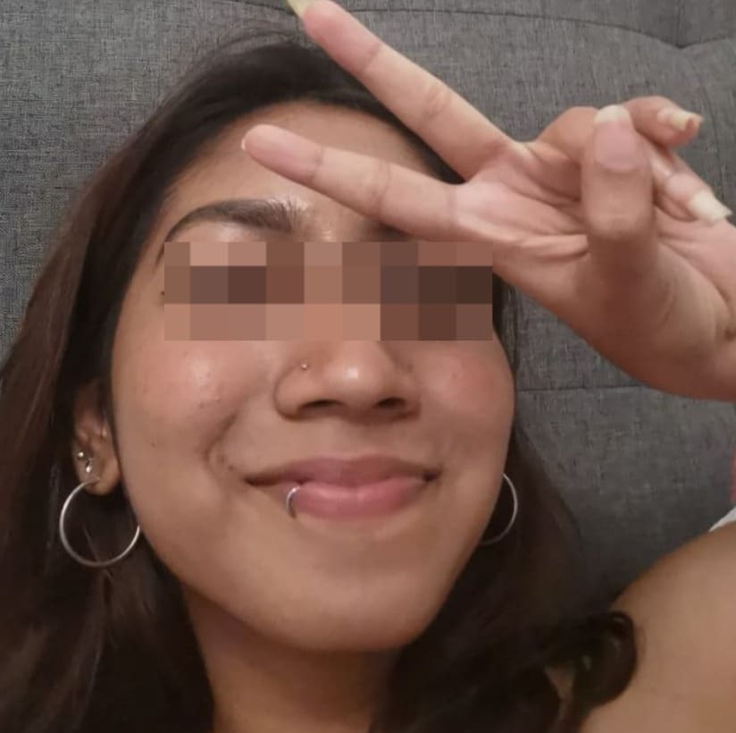 M'sian Woman Claims Face Was Severely Damaged By Laser Treatment, Beauty Clinic Denies Allegations