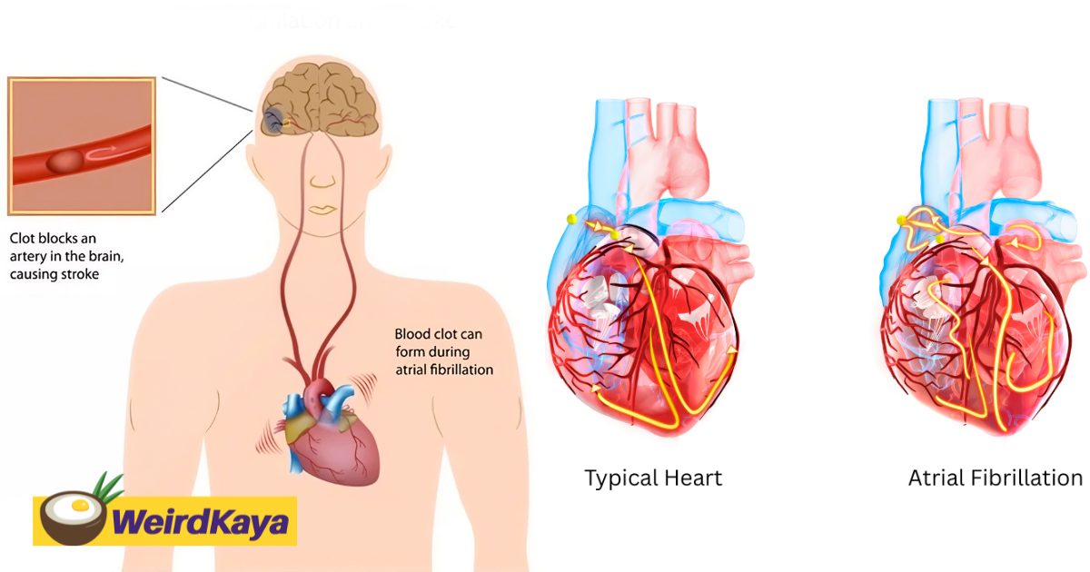 Atrial Fibrillation: Hidden Stroke Threat Affecting Malaysians | WeirdKaya