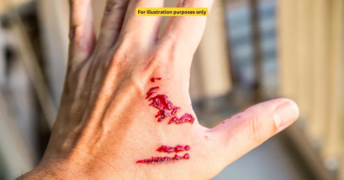  wk bite on hand 