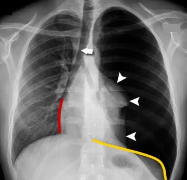 30yo M’sian Man Nearly Dies From Collapsed Lung, Admits Smoking Since 15 Was His Biggest Regret