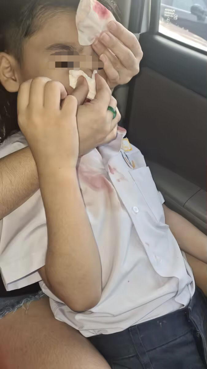 8yo m'sian boy suffering from nosebleeds