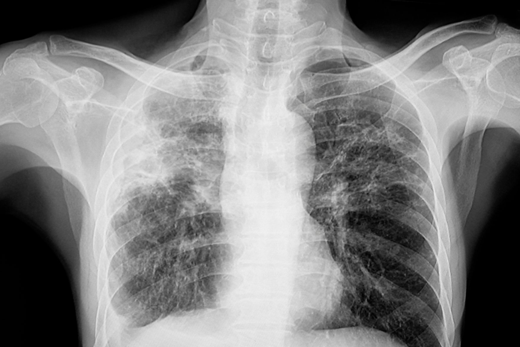 Chest X-ray showing pulmonary tuberculosis (TB) with predominant involvement of the upper lobes, which may affect the left, right, or both lungs