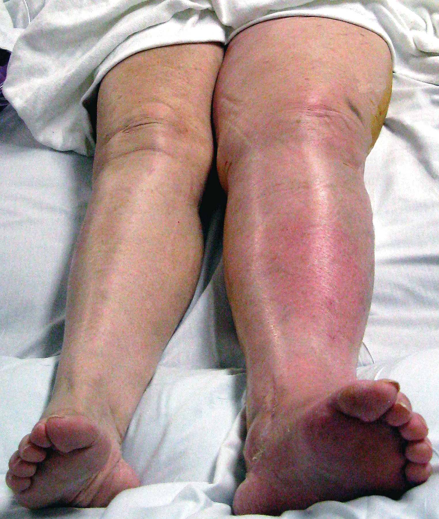 DVT symptom