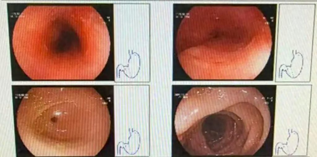 Hot pot ulcer (1)