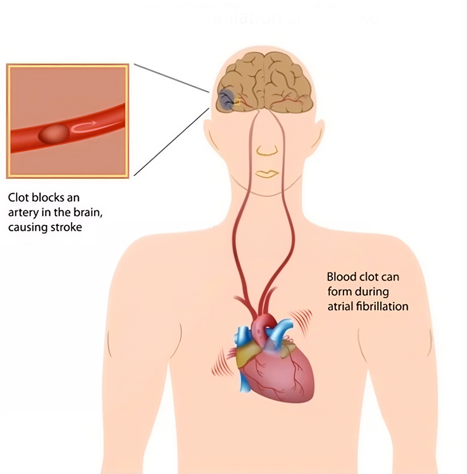 PIC 2 Atrial Fibrillation