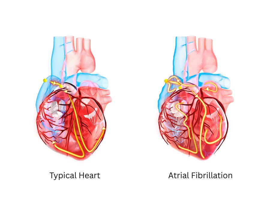 PIC 3_Atrial Fibrillation