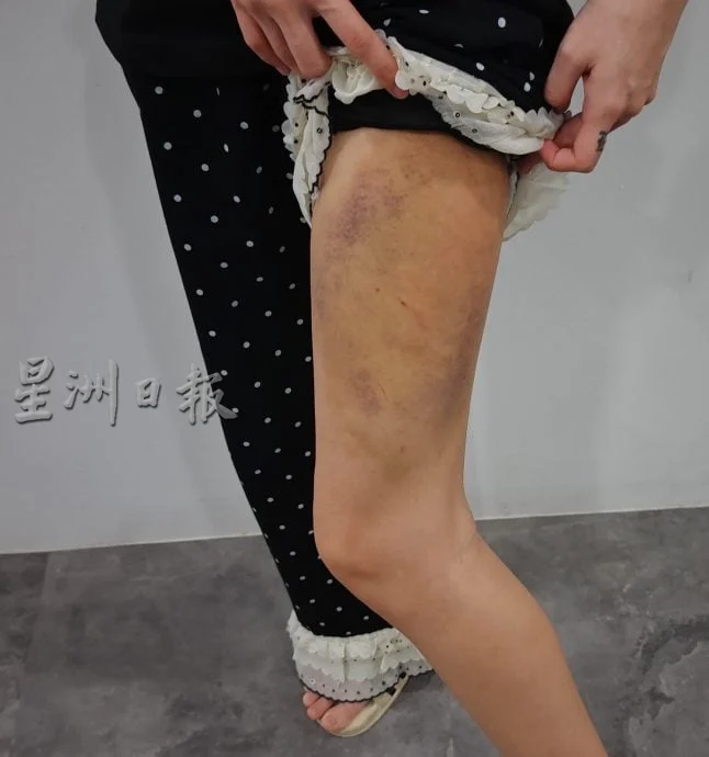 Single mum beaten by BF (2)