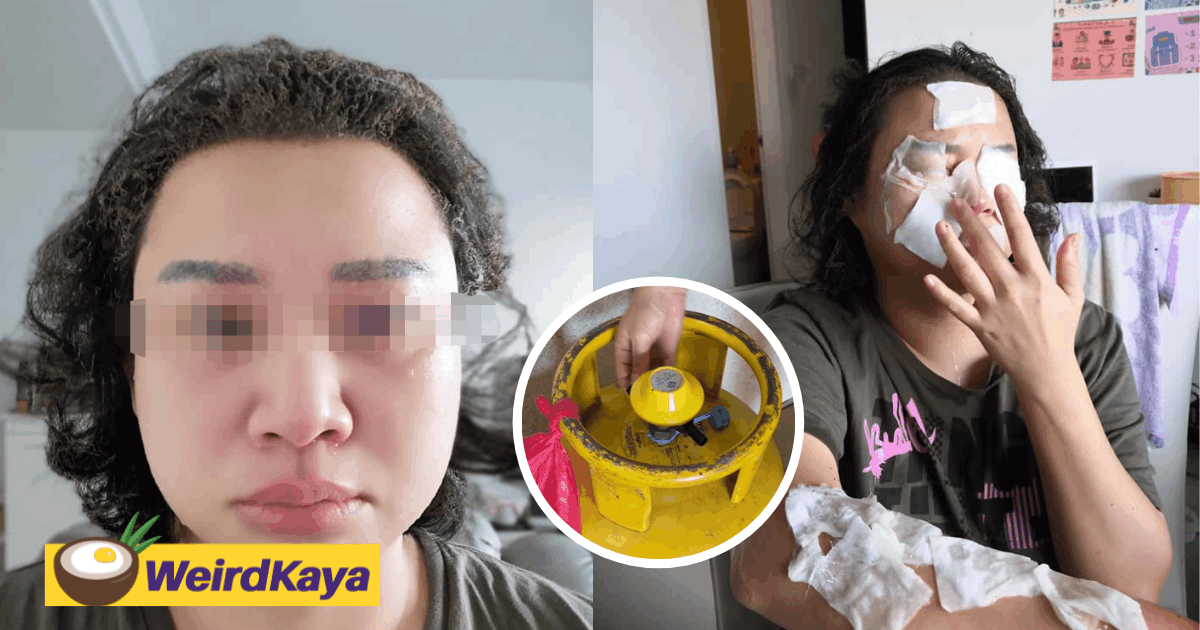 Woman shares how gas leak left her with “sausage lips”, afro hair and minor burns | weirdkaya