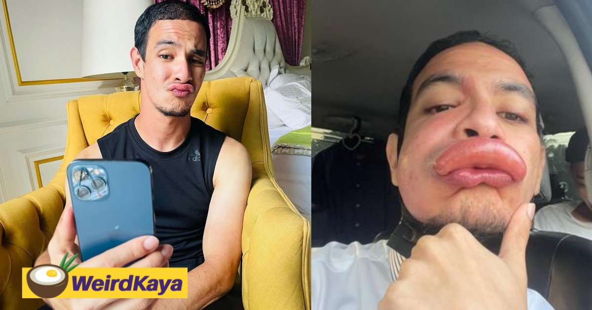 M'sian artist suffers severe swelling at his lip after getting stung by a bee | weirdkaya