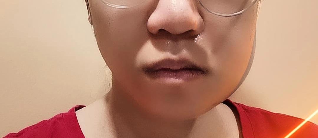 Swollen after wisdom teeth removed