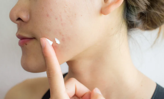 Cancer-causing chemical detected in acne treatments from leading brands | weirdkaya