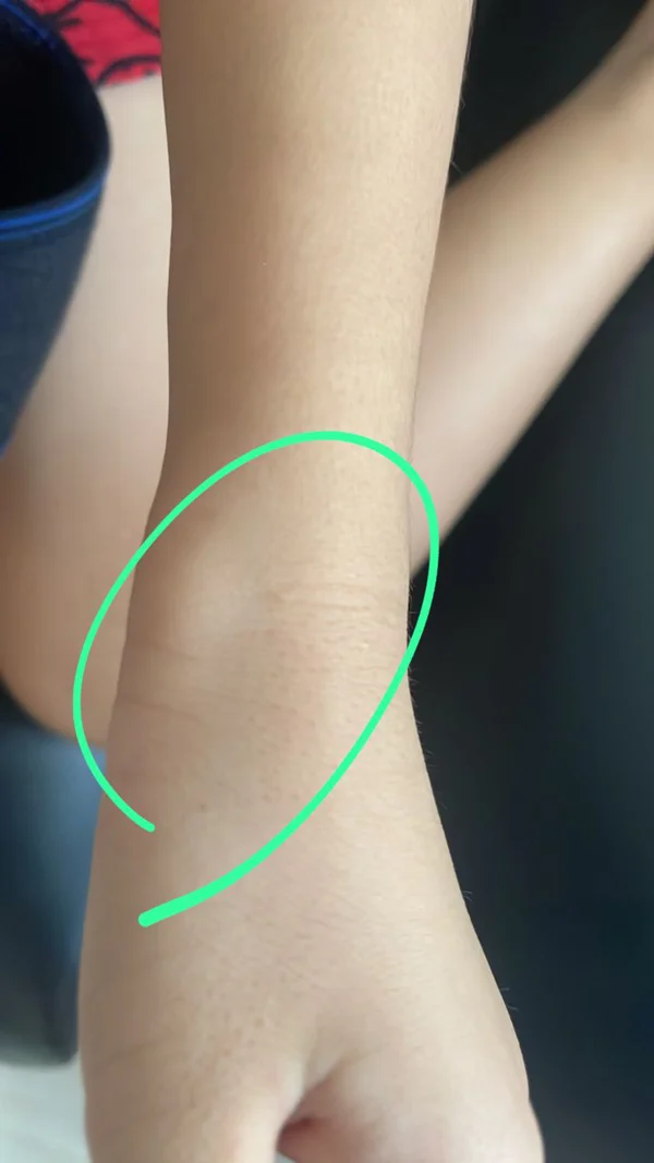 Bruise left on girl's arm due to caning
