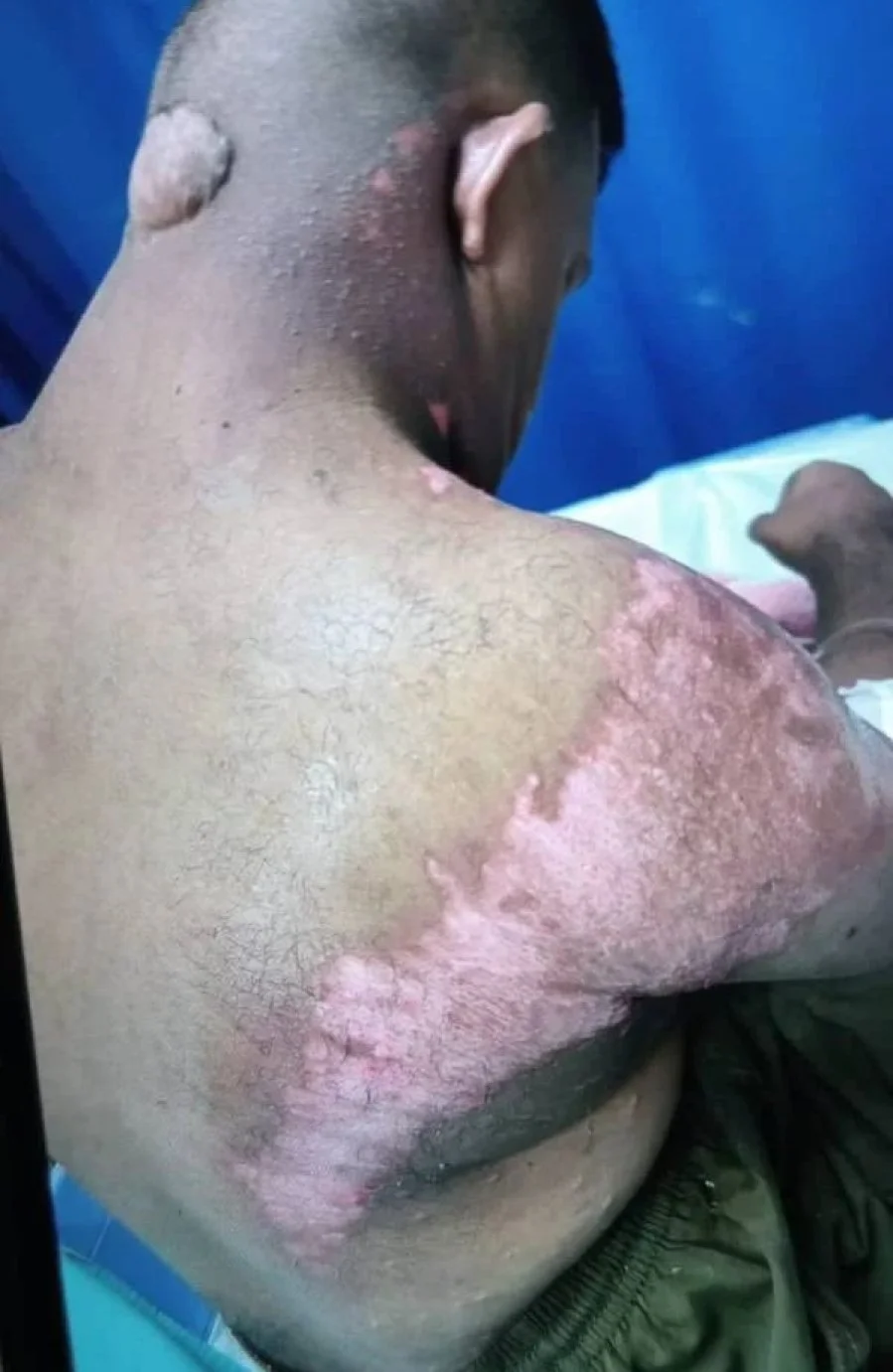 Burn wounds on man with down syndrome's body