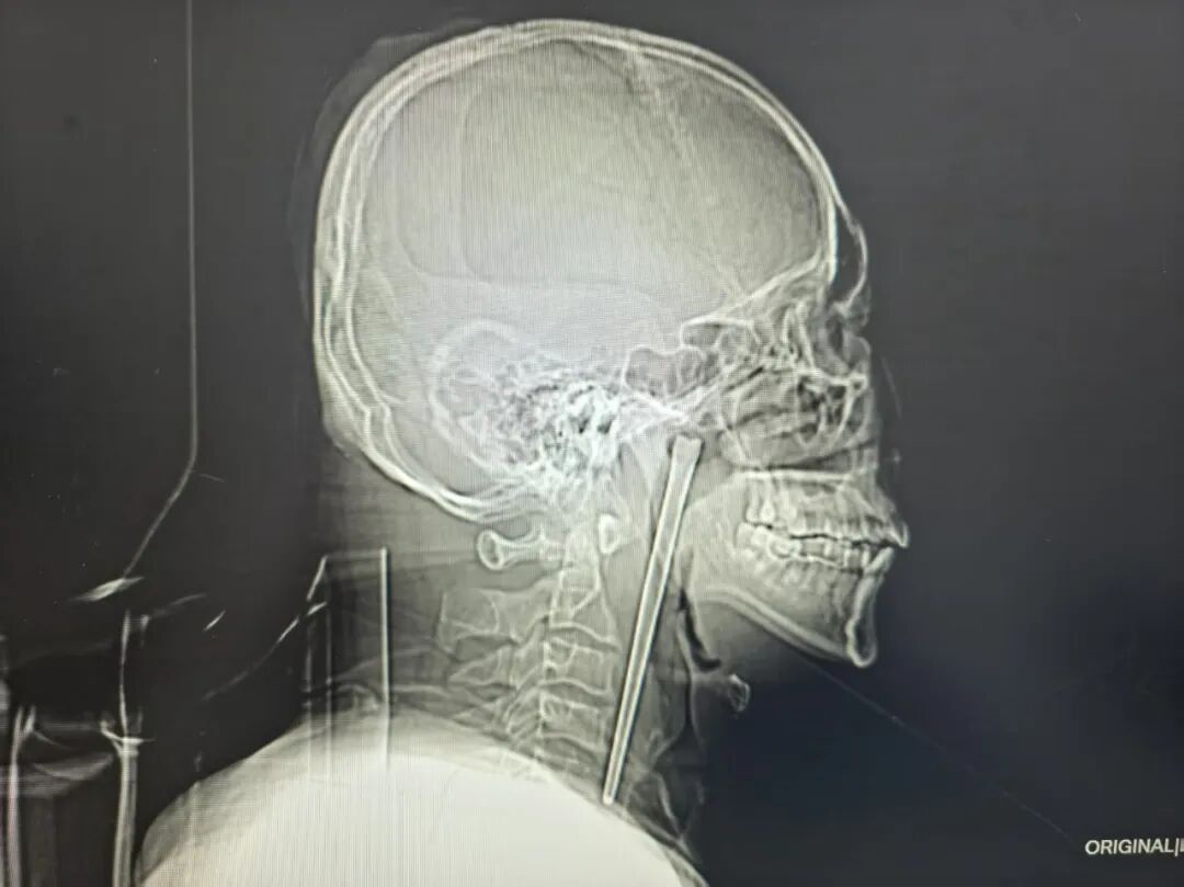 Chopstick inside throat (1)