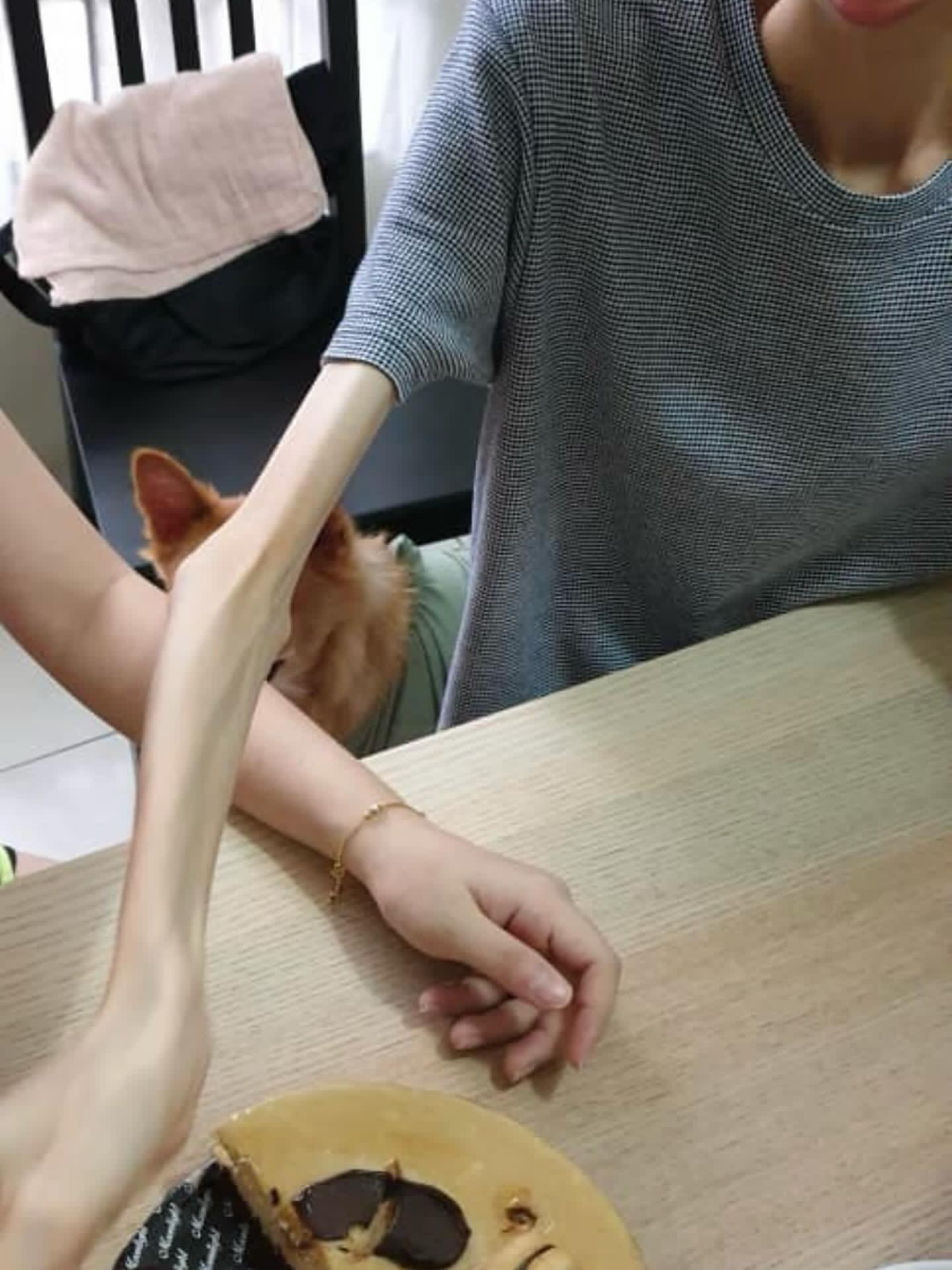 Comparison of fion's arm with anorexia vs normal people