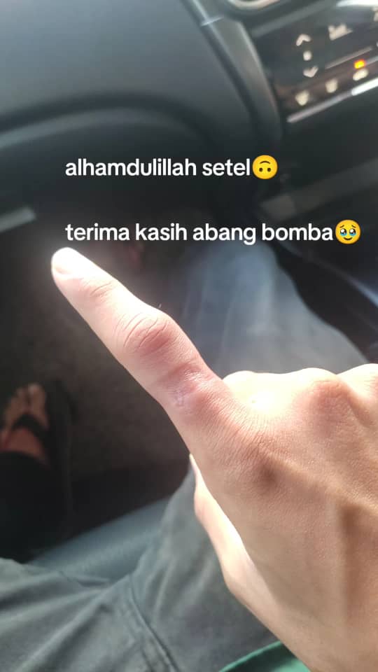 M'sian man calls bomba to remove ring which got stuck around his finger for 24 hours | weirdkaya