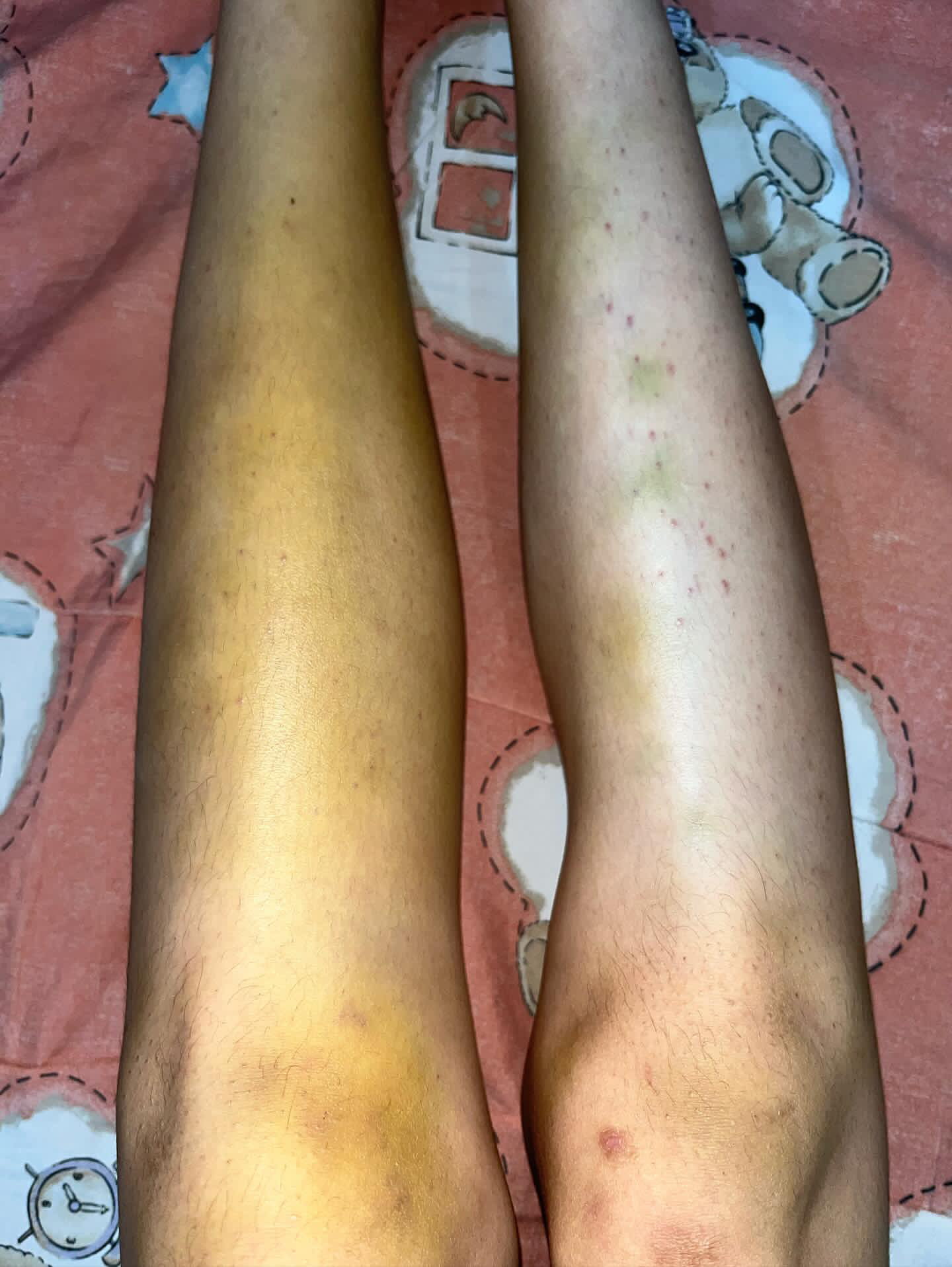 Fion's bruises after falling down due to anorexia