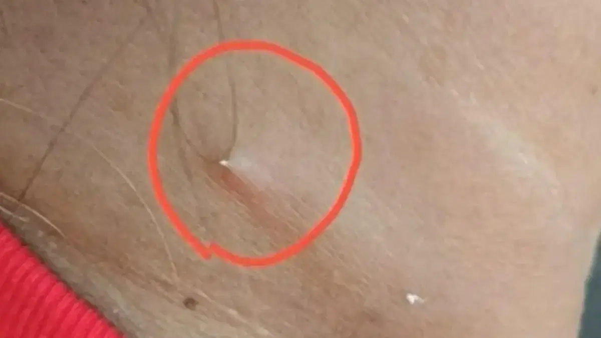 Fish bone seen piercing Thai woman's neck