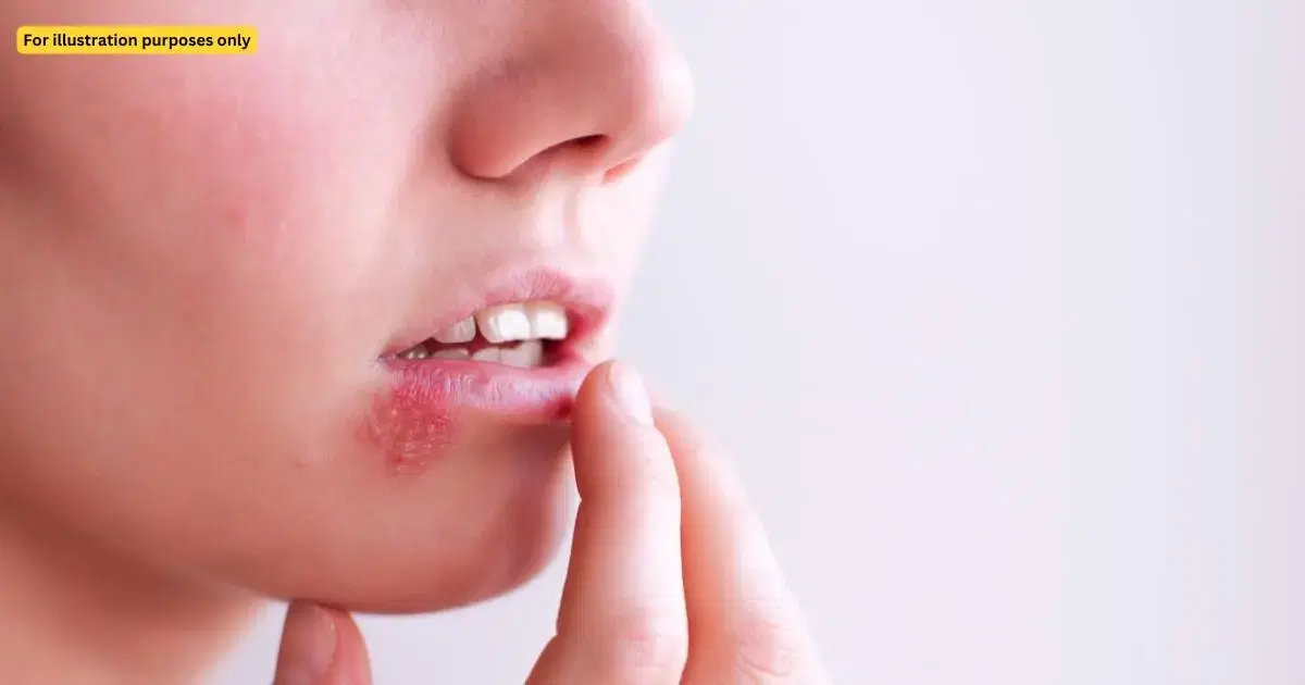 herpes