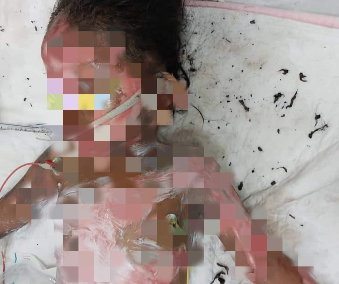 4yo m'sian girl suffers burns to 46% of her body while playing firecrackers with her siblings