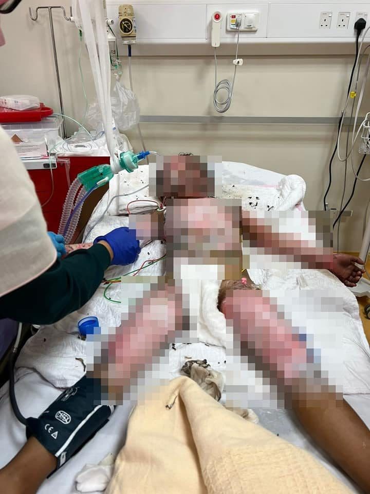 4yo M'sian Girl Suffers Burns To 46% Of Her Body While Playing Firecrackers With Her Siblings
