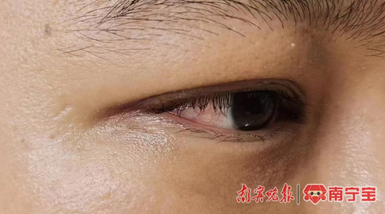 China man contracts gonorrhoea after using hotel towel to wipe his face during a business trip
