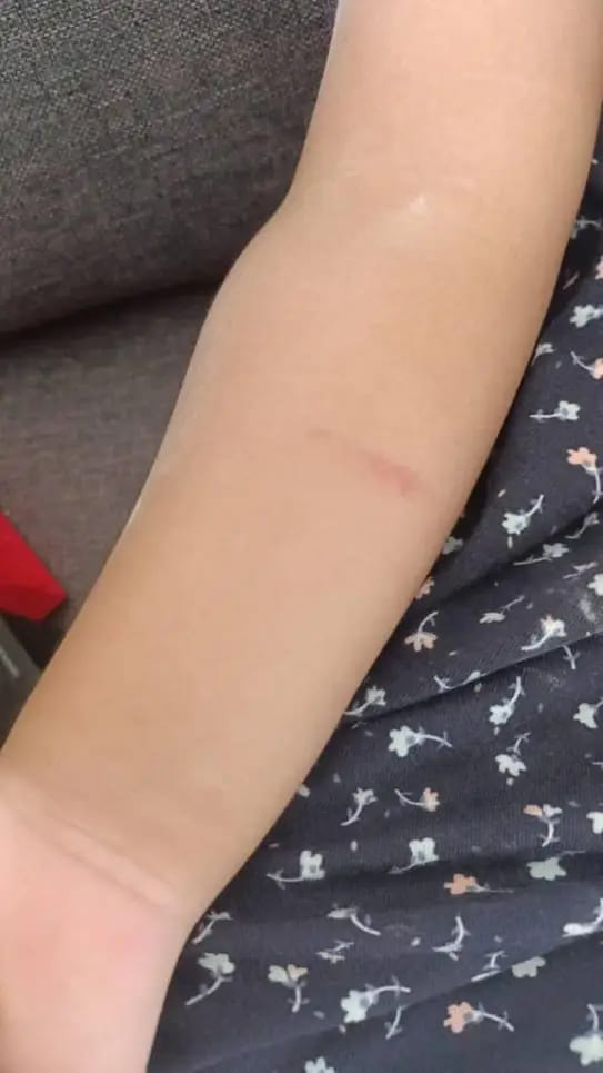 Bruises on the kid's hand after being abused by the babysitter