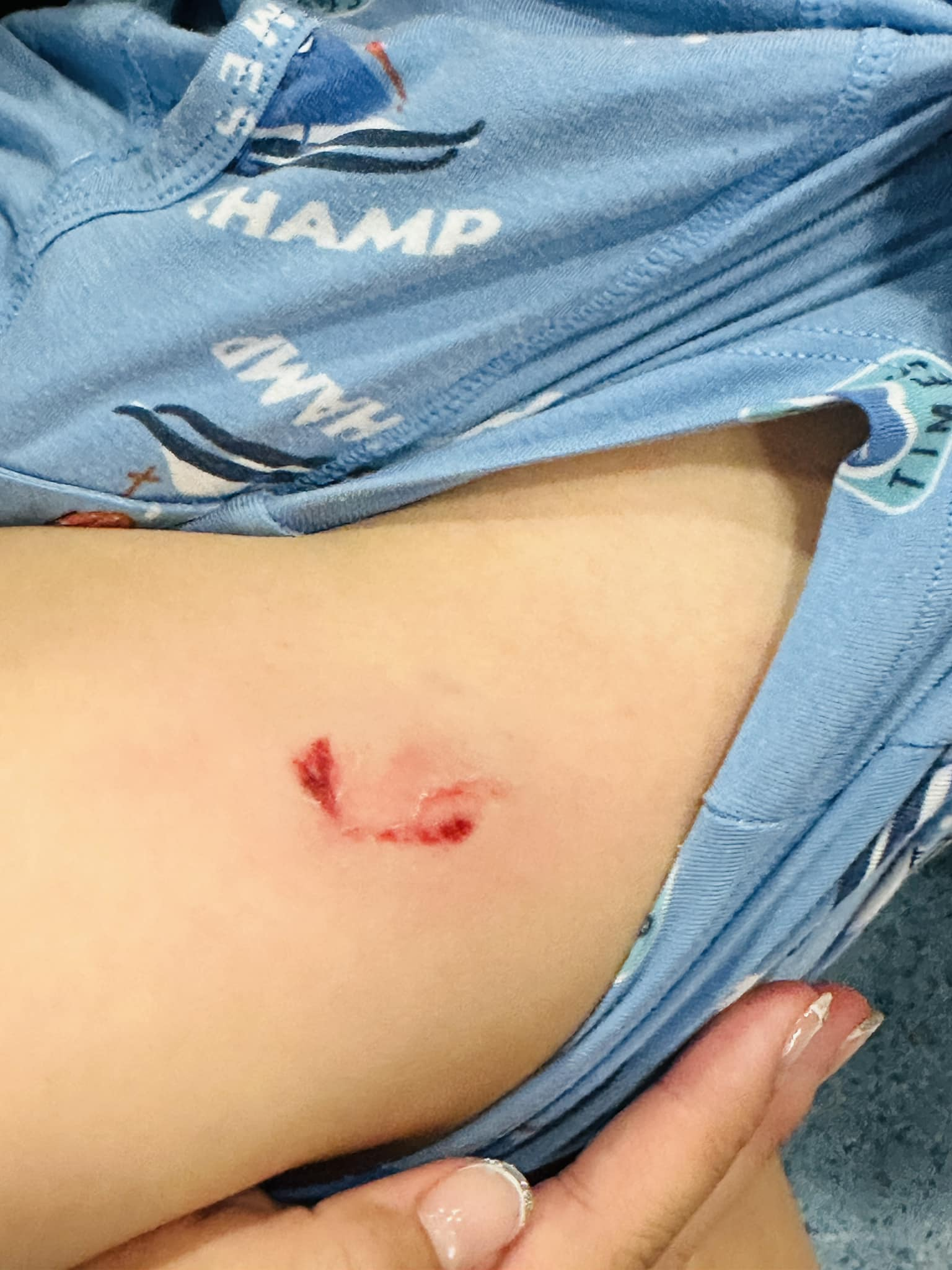 Bite marks left by dog who attacked 4yo boy at gardens by the bay