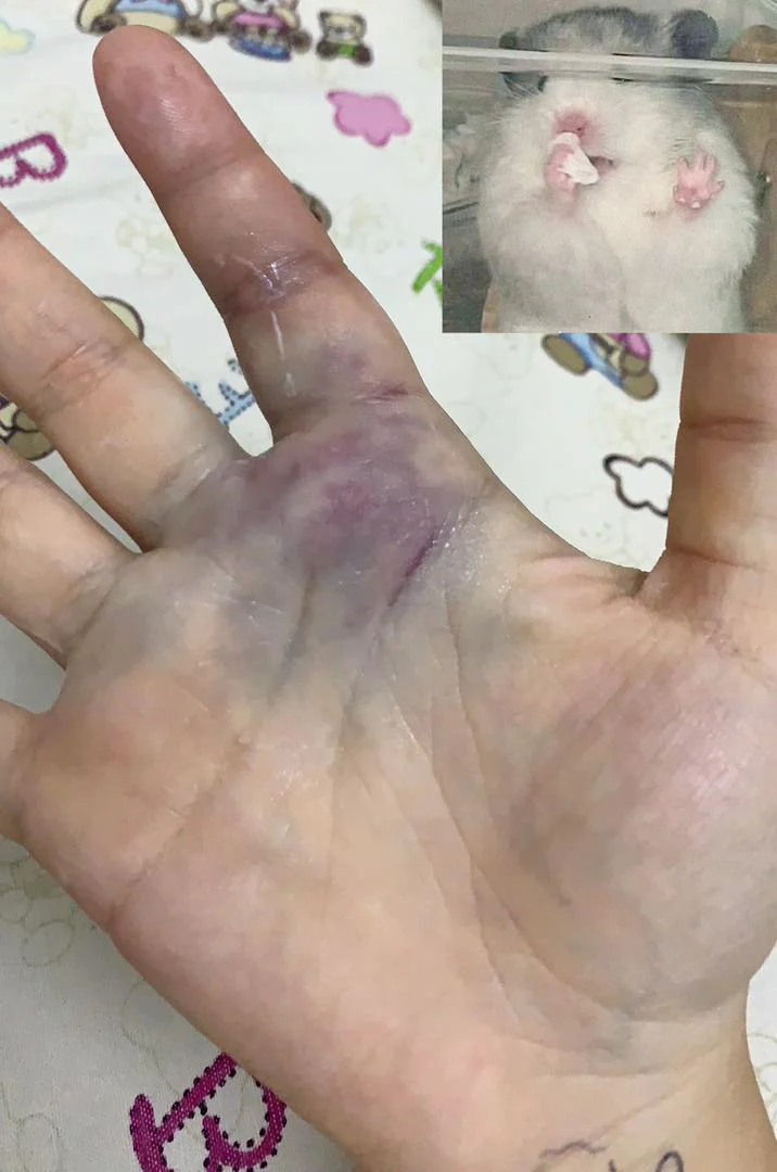 China student's bruised hand after she was attacked by grab driver in kuantan
