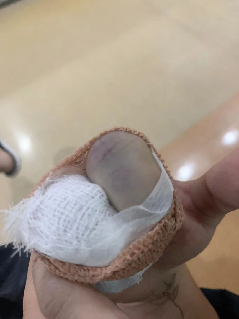 China student's fractured fingers after she was attacked by grab driver in kuantan