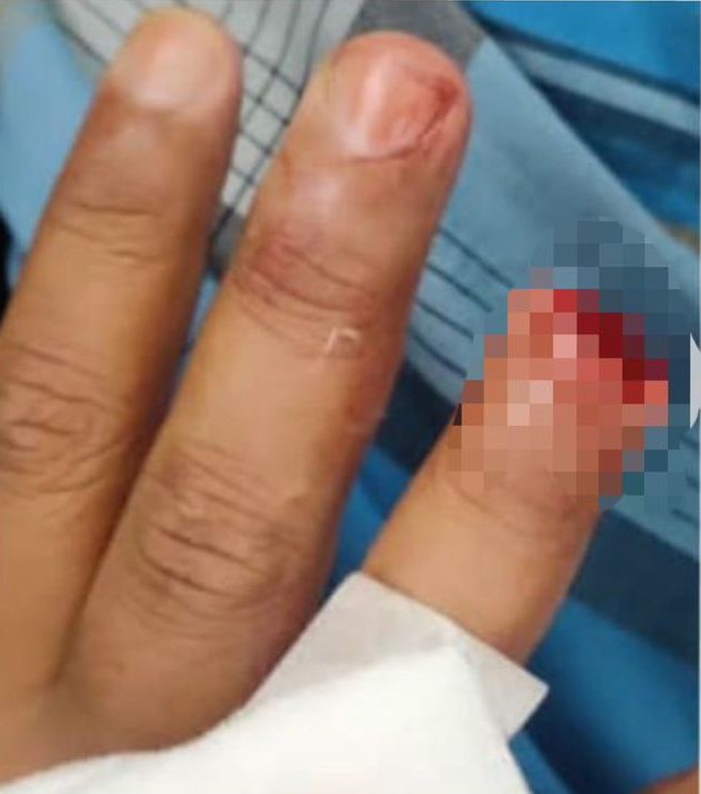 M'sian police officer gets finger bitten off by man who threatened to splash acid