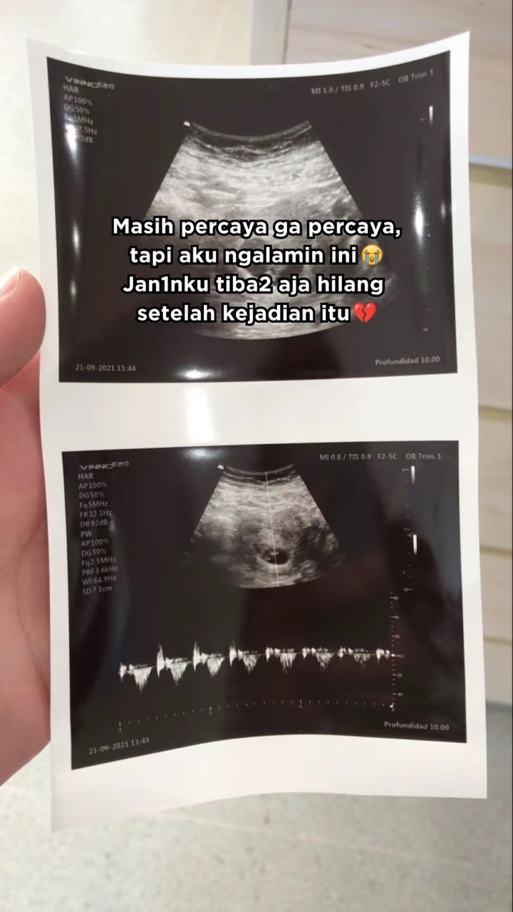 X-ray photo of baby inside m'sian woman's womb