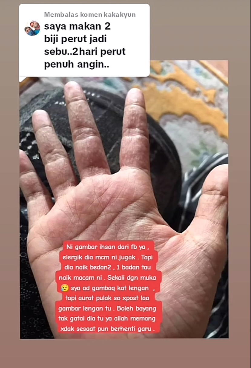 M'sian woman rushed to er due to severe allergic reaction after eating donut peach | weirdkaya