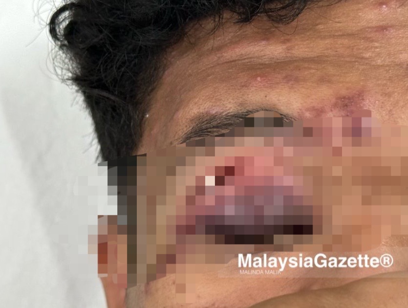 M'sian student allegedly caned by teacher on the eye for vaping, nearly goes blind | weirdkaya