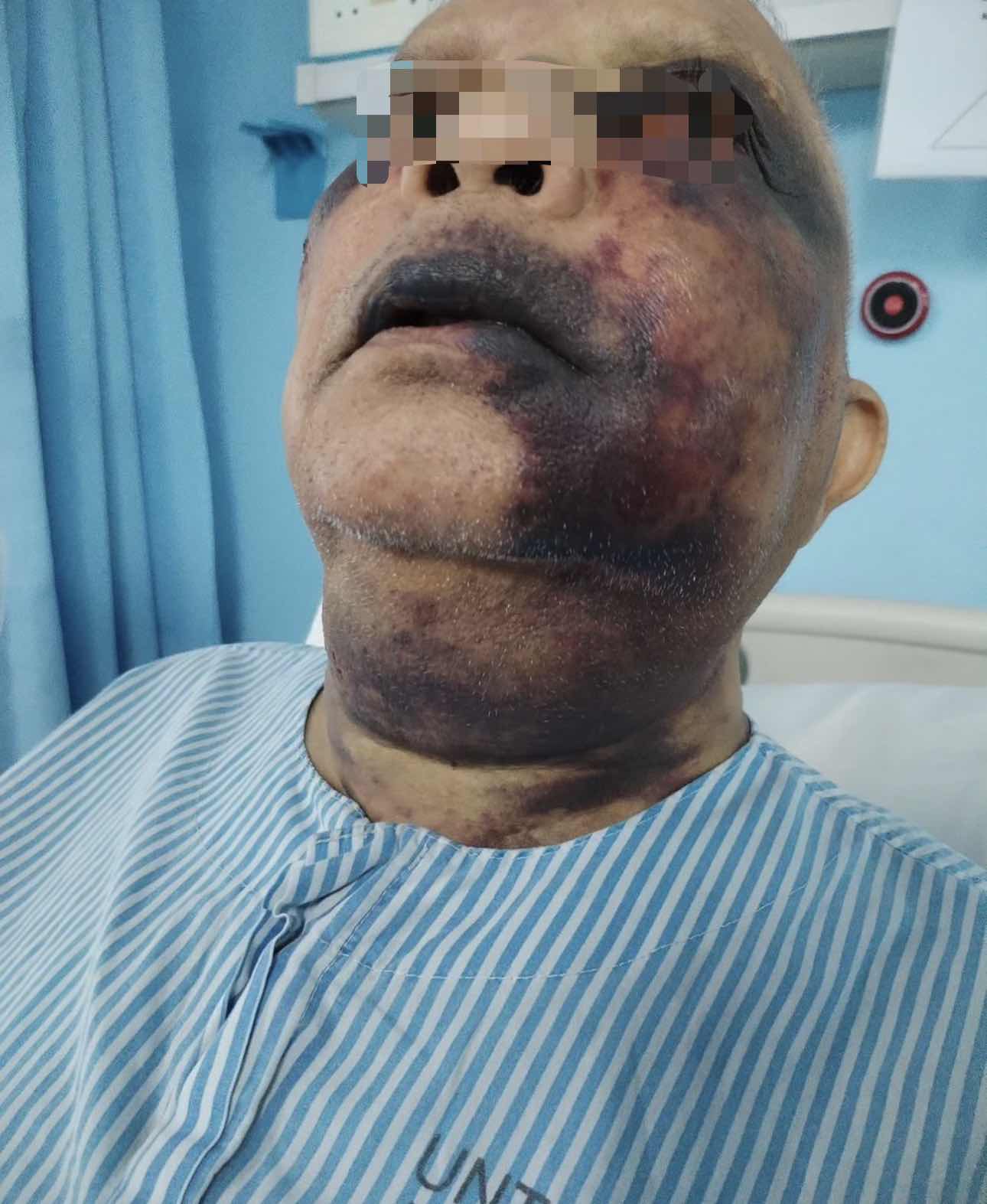 Elderly man with horrible scars and injuries