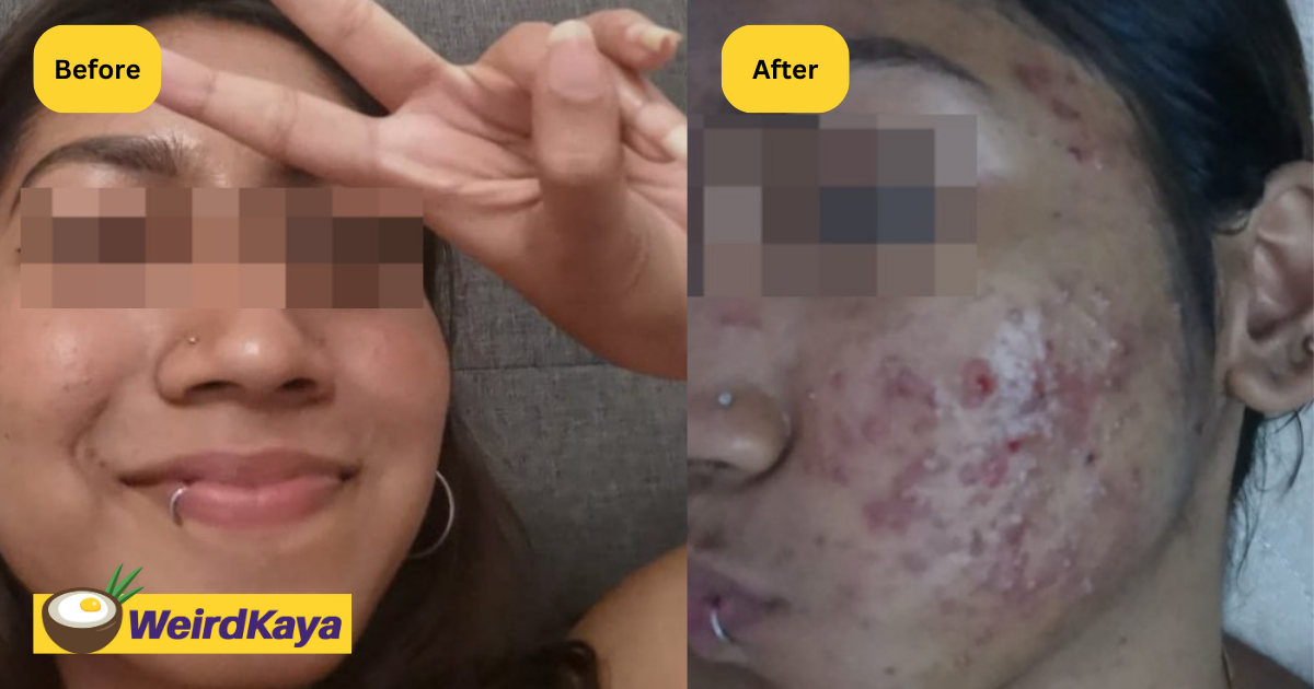 M'sian woman claims face was severely damaged by laser treatment, beauty clinic denies allegations | weirdkaya