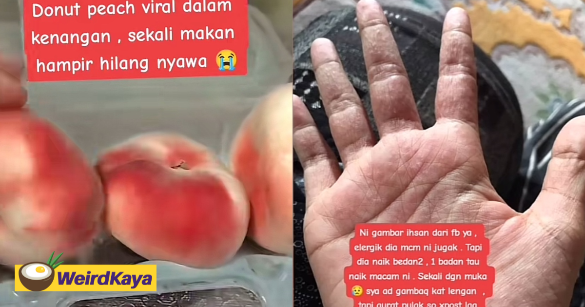M'sian woman rushed to er due to severe allergic reaction after eating donut peach | weirdkaya