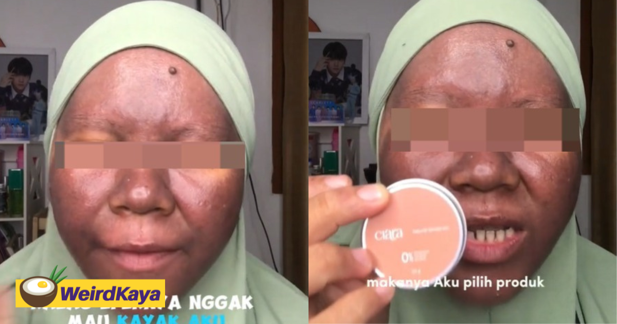 Indonesian woman's skin blackens after she used skincare product which had mercury | weirdkaya