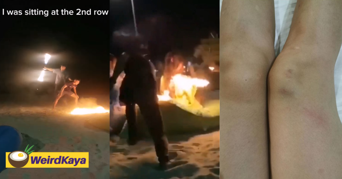M'sian woman suffers burns after performer drops fire baton on her leg | weirdkaya