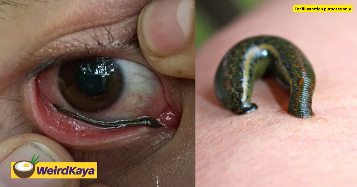 Leech Crawls Into Man's Eye, Making Him Spend More Than 30 Mins Getting It  Out
