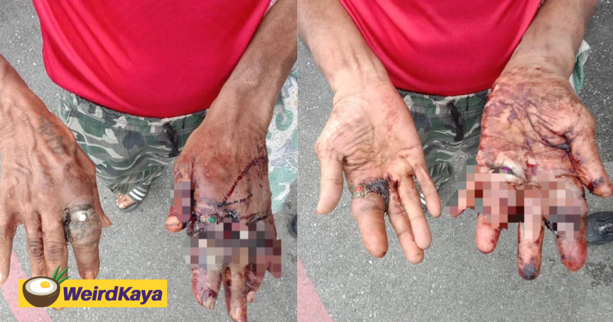 M'sian man's hands swell & rot as his rings were worn too tightly | weirdkaya
